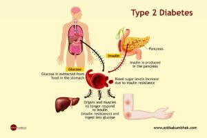 Type 2 Diabetes